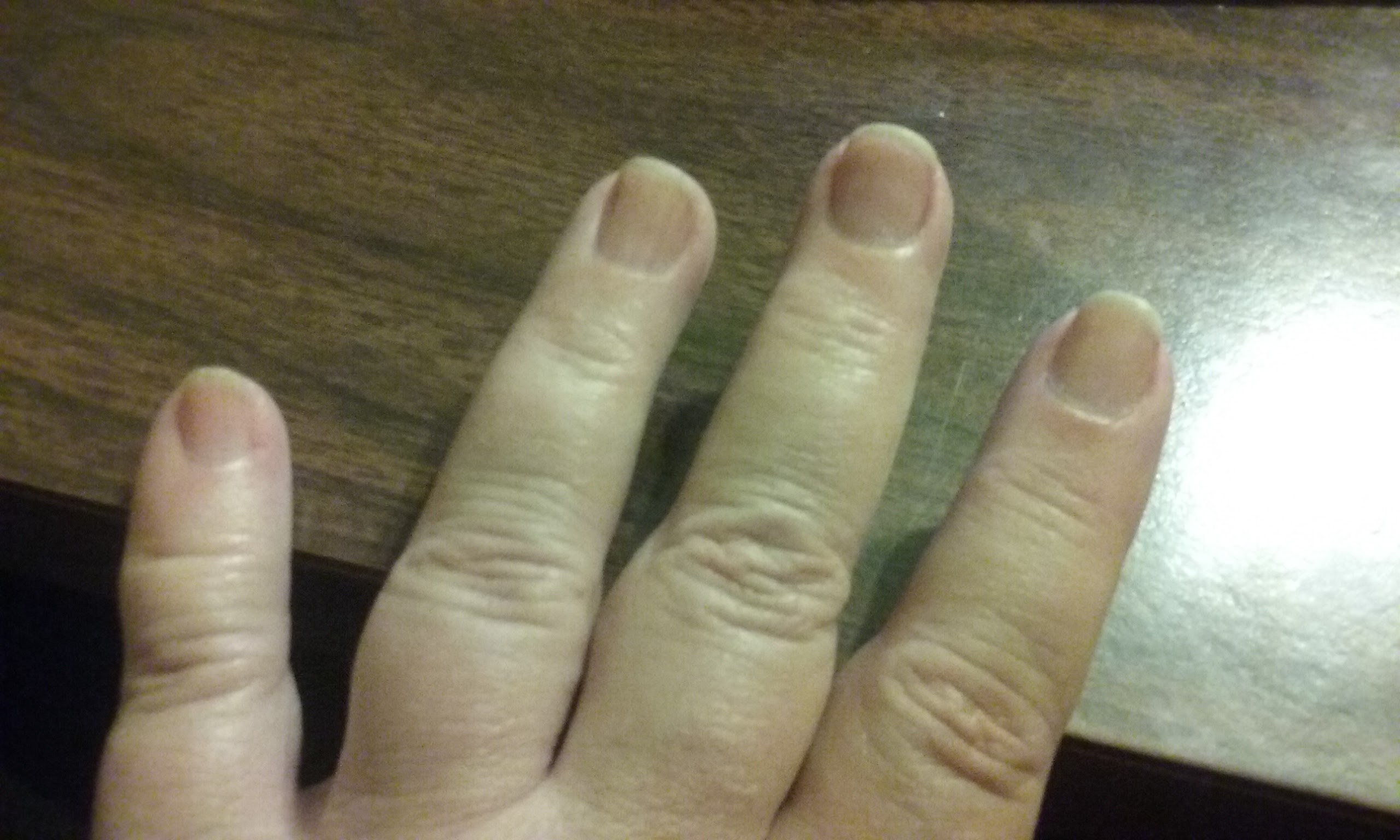 Nail treatment improved nails